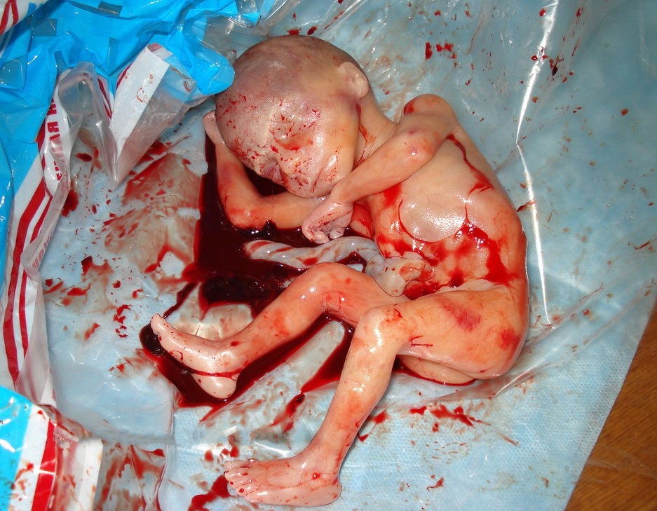 Tylko nie pokazujcie, jak wygląda aborcja!