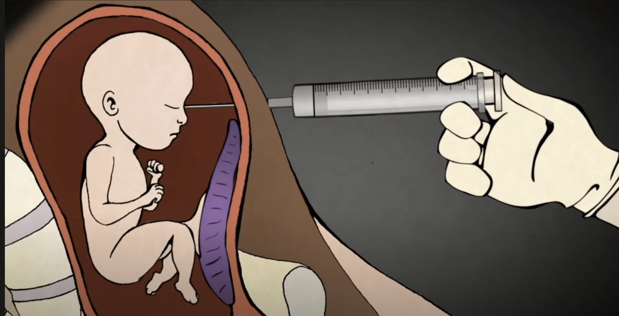 Aborcja w 3. trymestrze ciąży