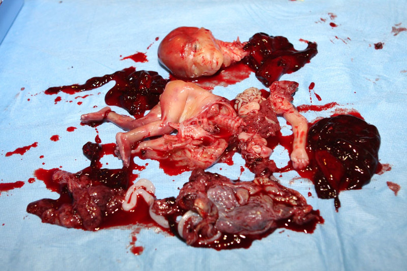Położnik bez lukru, a może bez serca? Kaja Godek odpowiada zwolenniczce aborcji / foto ilustracyjne - aborcja w 27 tygodniu ciąży